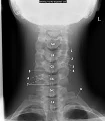 This procedure may be used to diagnose back or neck pain, fractures or broken bones, arthritis, degeneration of the disks, tumors, or other problems. Interpreting Cervical Spine Radiographs The Bmj