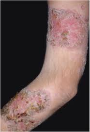 Image result for Pyoderma Gangrenosum