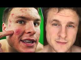 Red spots and acne scars: Remove Redness From Acne Scarring Youtube