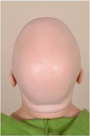 Alopecia universalis (au), also known as alopecia areata universalis, is a medical condition alopecia universalis can occur at any age, and is currently believed to be an autoimmune disorder. Example Of Patient With Severe Alopecia Areata Alopecia Universalis Download Scientific Diagram
