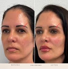 Dermal-Fillers-Katy, Tx| Viata Aesthetics and Wellness| Candace Craioveanu,  RN