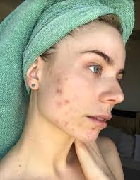 Maybe you would like to learn more about one of these? Blogger 28 Who Suffered Painful Cystic Acne Reveals The Five Step Process That Cleared Her Skin In Six Weeks