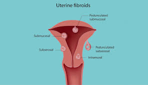 If your doctor suspects you have fibroids, he or she might order imaging studies of your uterus. Uterine Fibroids The Fibroid Center