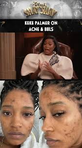 If I can go into the doctors and get me a fat 🍑, why can't I get me a  clean skin? It sucks."