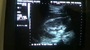 Ultrasound For Renal Stone Youtube