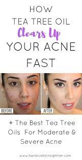 Best Tea Tree Oil For Acne Of 2021 Does It Work My Reviews Tea Tree Oil For Acne Best Tea Tree Oil Tea Tree Oil Uses