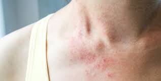 You feel a surprise itch, and when you reach down to scratch your skin feels rough and bumpy. Why A Skin Rash May Be A Coronavirus Symptom According To Doctors