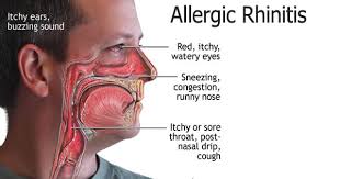 Image result for Allergic Rhinitis