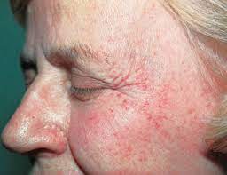 When purpura spots are less than 4 mm in diameter, they are called petechiae. Images Of Petechiae On Face Pet S Gallery