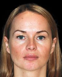 Digital platform for planning facial asymmetry orthodontic-surgical  treatment preparation