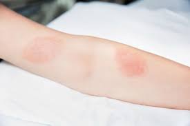 How do you know when poison ivy is going away? Poison Ivy Rash Treatment What Does A Poison Ivy Rash Look Like