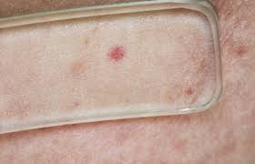 Image result for Diascopy