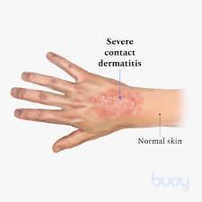Image result for dermatitis contacta