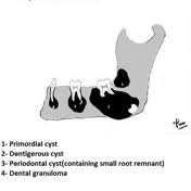 Lucent Lesions Of The Jaw Radiology Reference Article Radiopaedia Org Radiology Oral Pathology Facial Bones