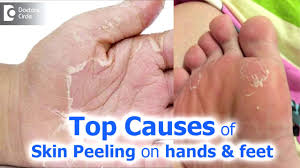 Finger and toe peeling is attributed to kawasaki in the second phase where the following additional symptoms are noticeable in the 2nd to 4th week of. Skin Peeling On Hands Feet Causes Treatment Dr Rajdeep Mysore Youtube