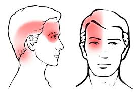 Cervicogenic Headaches: All You Need to Know - Pain Away Clinic
