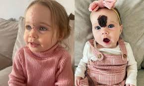 Znamię tej dziewczynki lekarze widzieli na USG. Nie zdecydowali się usunąć.  Dlaczego?