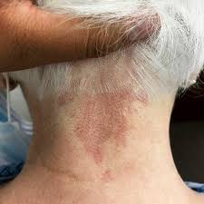 Image result for Nevus Simplex