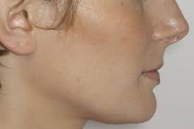 We did not find results for: Machoire Du Bas En Retrait Et Autres Decalages Quelle Orthodontie