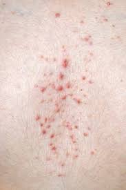 Los alérgenos desencadenan reacciones alérgicas y pueden provenir de ciertos jabones, cremas y hasta de las mascotas. Erupciones Y Reacciones Medicamentosas Trastornos Dermatologicos Manual Merck Version Para Profesionales