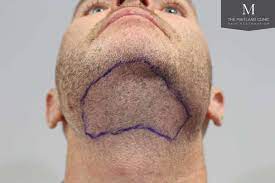 Another way in which heavy metals may interfere with normal hair growth is through their effect on your hormonal system. Body Hair Transplant Alliance4hair Com