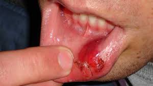 Dec 04, 2019 · more serious cuts may need dissolvable stitches or skin adhesive to help with healing and reduce scarring, she notes. How To Heal A Busted Lip 5 Home Remedies
