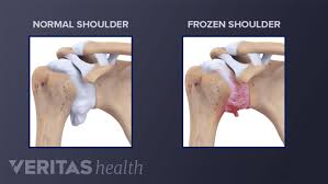 Image result for Frozen Shoulder