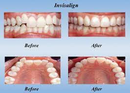 Generally, traditional braces take twice as long as invisalign, with most treatments lasting two years. How Long Does Invisalign Take Masri Orthodontics