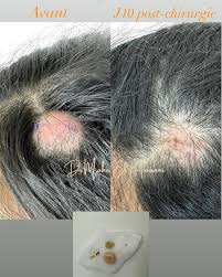 Exérèse d'un kyste du cuir chevelu