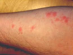 Magnified bed bugs picture source: Skin Reactions To Bed Bug Bites Vary 813 922 8475