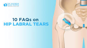 Image result for Hip Labral Tear