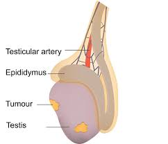 Backache and stomachache men who suffer from testicular cancer may experience some certain signs and symptoms. Testicular Cancer Healthdirect