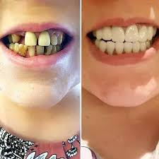 If your teeth are rotten and cause you pain or embarrassment, you should talk to a dental provider on ways to improve your dental health and the overall appearance of your smile. How To Fix Rotted Teeth