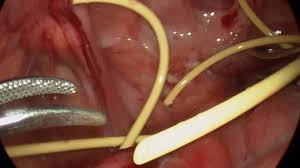 Laparoscopy Post Vp Shunt Pseudocyst Excision1min36sec Youtube