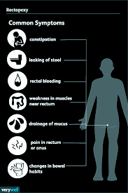 Image result for Rectal prolapse