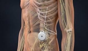 Image result for Intrathecal Pump