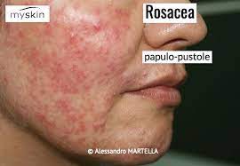 Epidermiology and significance in daily dermatologie practice. Rosacea Cause Sintomi E Terapia Myskin Dermatologi Online