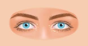 Image result for xanthelasma of eyelid