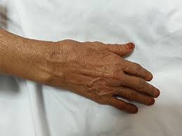 Photo Of The Right Hand Of The Patient Shows A Bulge At The Snuffbox Area Download Scientific Diagram 3.2 the cephalic vein at this site is often used for giving intravenous fluids. bulge at the snuffbox area