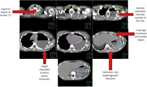 Mesothelioma causes & risk factors. The Use Of Radiation Therapy For The Treatment Of Malignant Pleural Mesothelioma Expert Opinion From The National Cancer Institute Thoracic Malignancy Steering Committee International Association For The Study Of Lung Cancer And