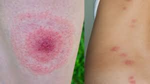 Image result for scabies bite