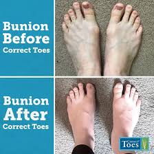 Whether you are on your feet all day, are a runner or simply love your high. Correct Toes Australia Natural Foot Health Natural Foot Health