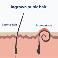 This article will tackle the fundamental differences, including symptoms, diagnoses, and treatment of ingrown hair vs. What Is An Ingrown Pubic Hair Roman Healthguide