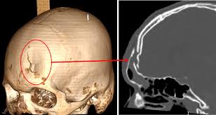 Image result for Frontal Bone