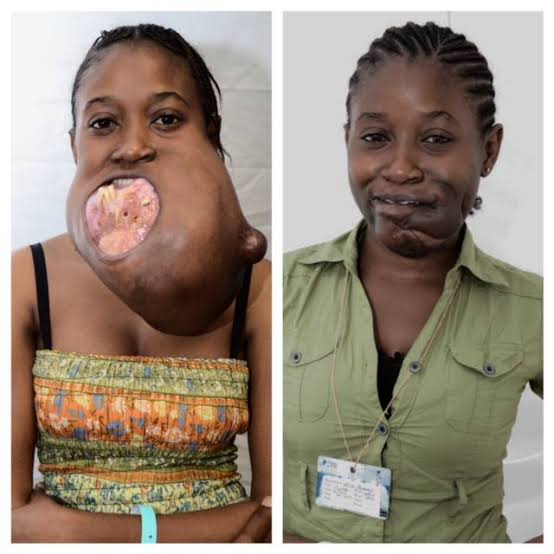 Mercy - Remember Grace? She was the first patient up the gangway in Congo to have surgery, removing the massive tumor from her face. Five weeks later and she is looking like