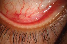 Image result for Eye Foreign Body