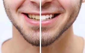 Image result for Teeth Whitening