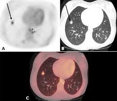 Prostate cancer that spreads or comes back after treatment is often small and hard to detect. Early Breast Cancer Diagnosis With Pet Ct Scan Combination Medical Articles By Dr Ray