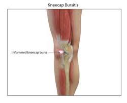 Image result for Prepatellar Bursitis