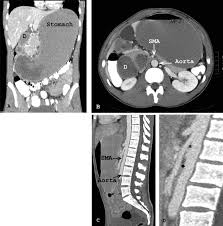 Emergency Department Presentation Of Superior Mesenteric Artery Syndrome Two Cases In Marine Corps Recruits Journal Of Emergency Medicine
